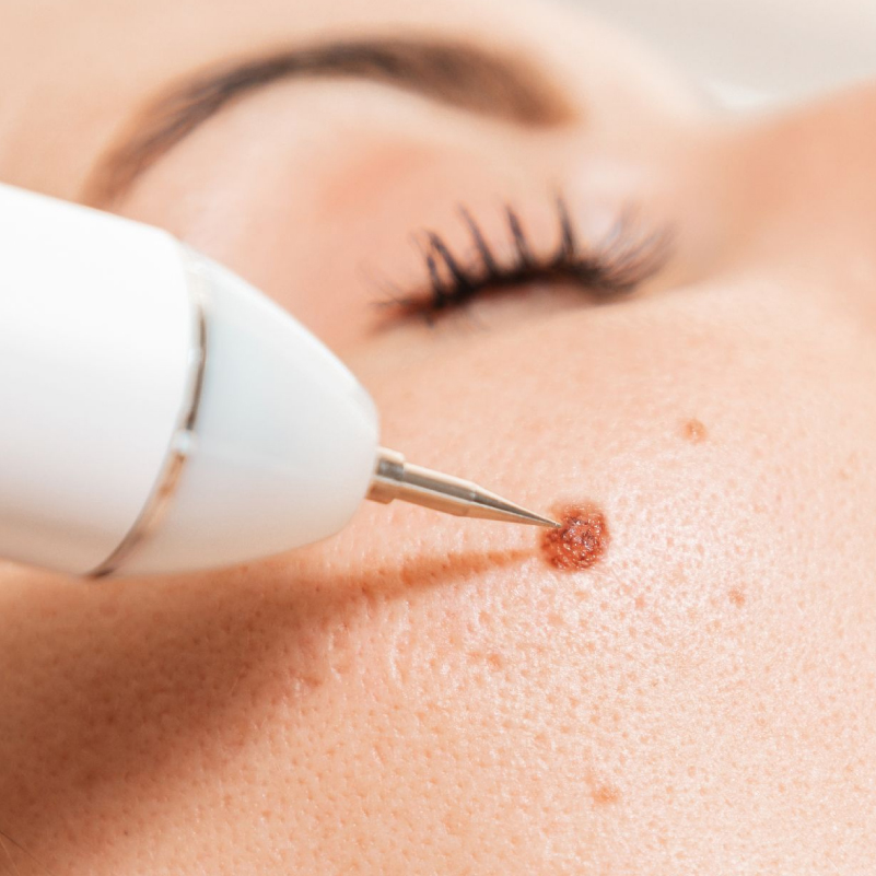 11 eliminaciÓn de verrugas