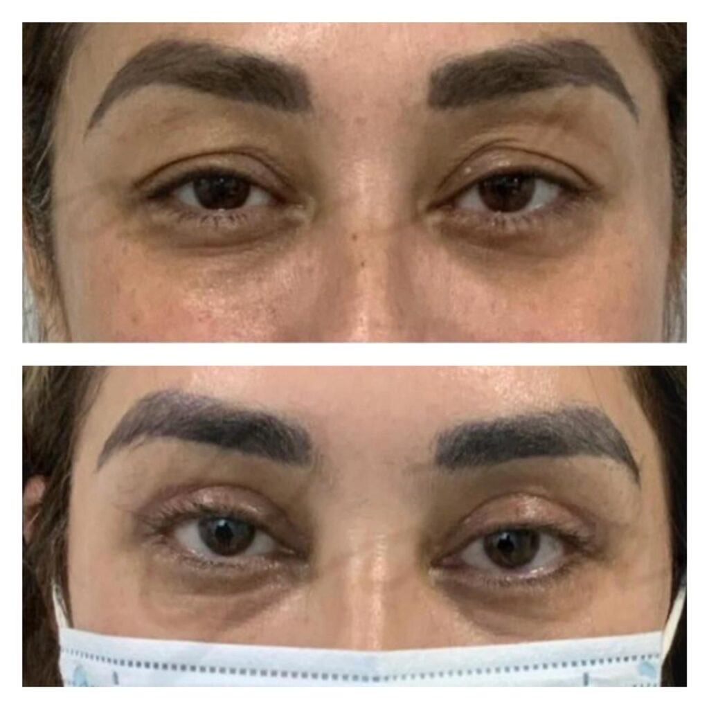 cirugía de parpados mujer (1)