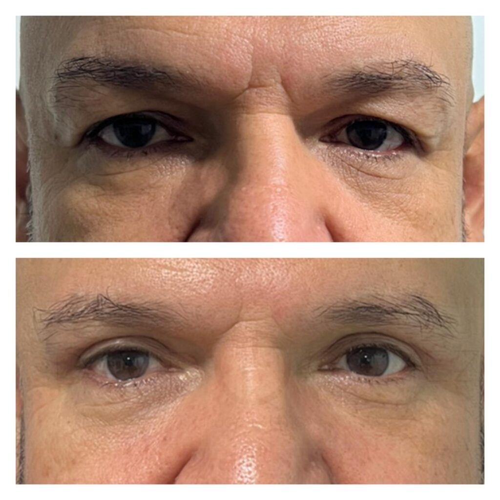 cirugía de parpados hombre (1)