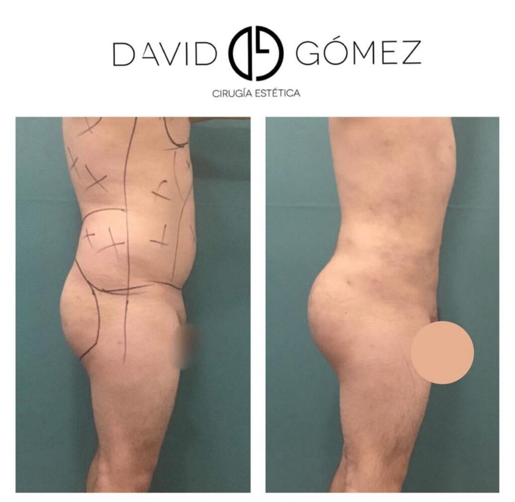 Liposucción lipo cirugía