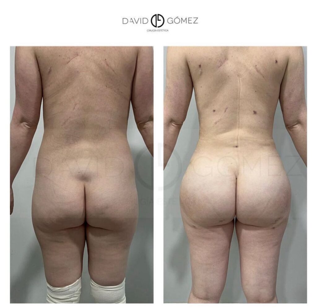 Liposucción lipo cirugía estética