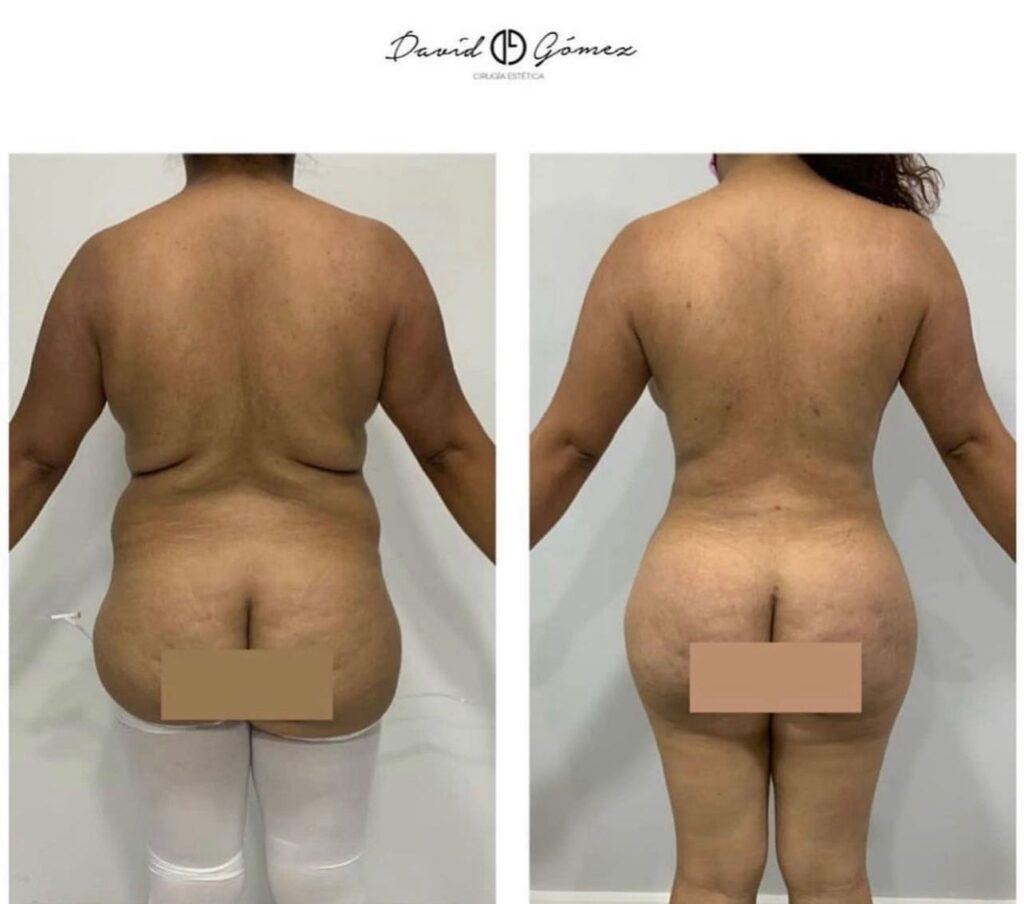 Liposucción lipo corvalen sugery