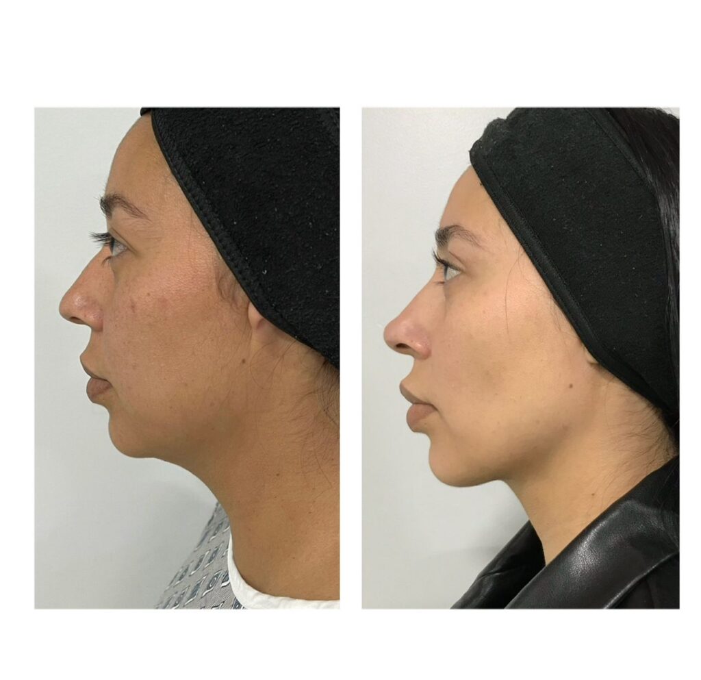 Liposucción de papada liposucciÓn de papada