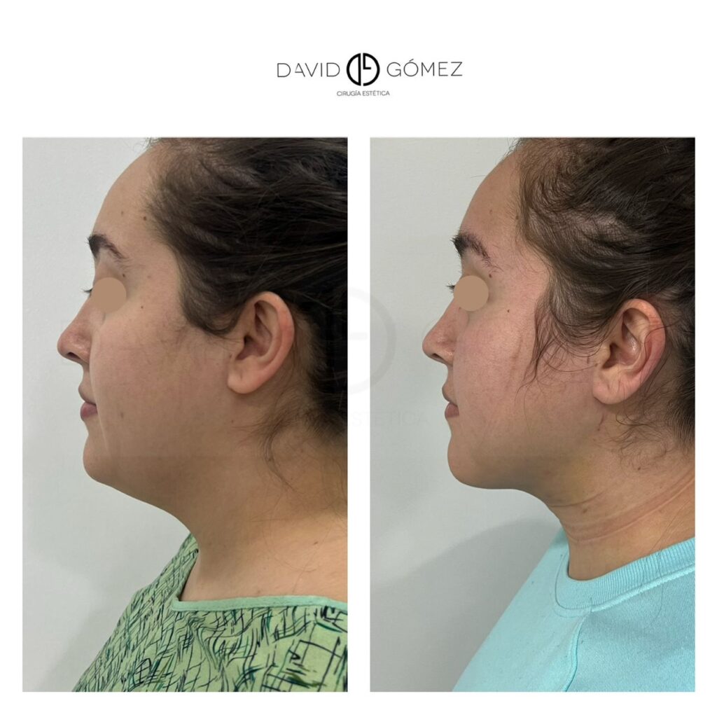 Liposucción de papada liposucciÓn de papada cirugía