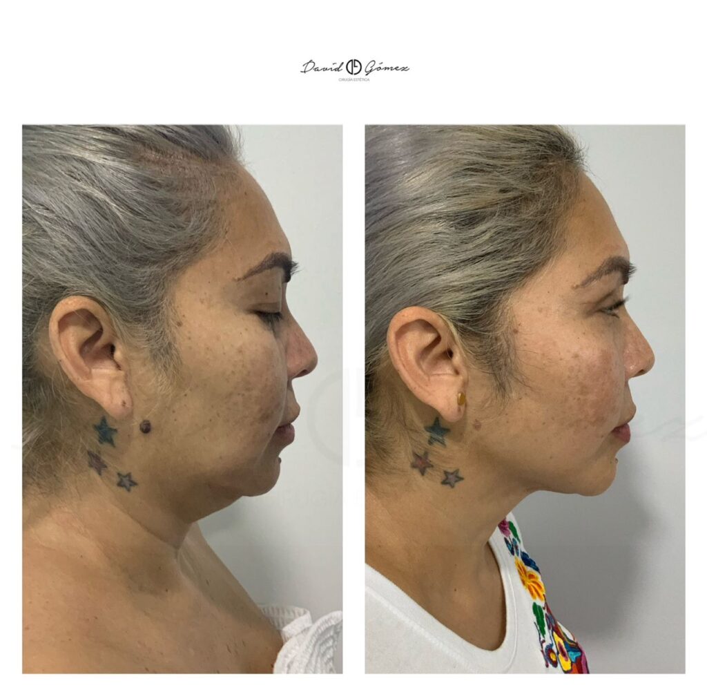 Liposucción de papada liposucciÓn de papada cirugía estética