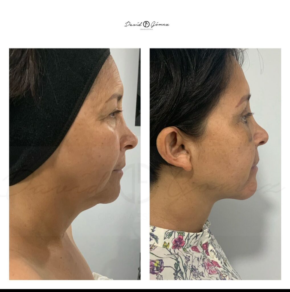 Liposucción de papada liposucciÓn de papada corvalen sugery