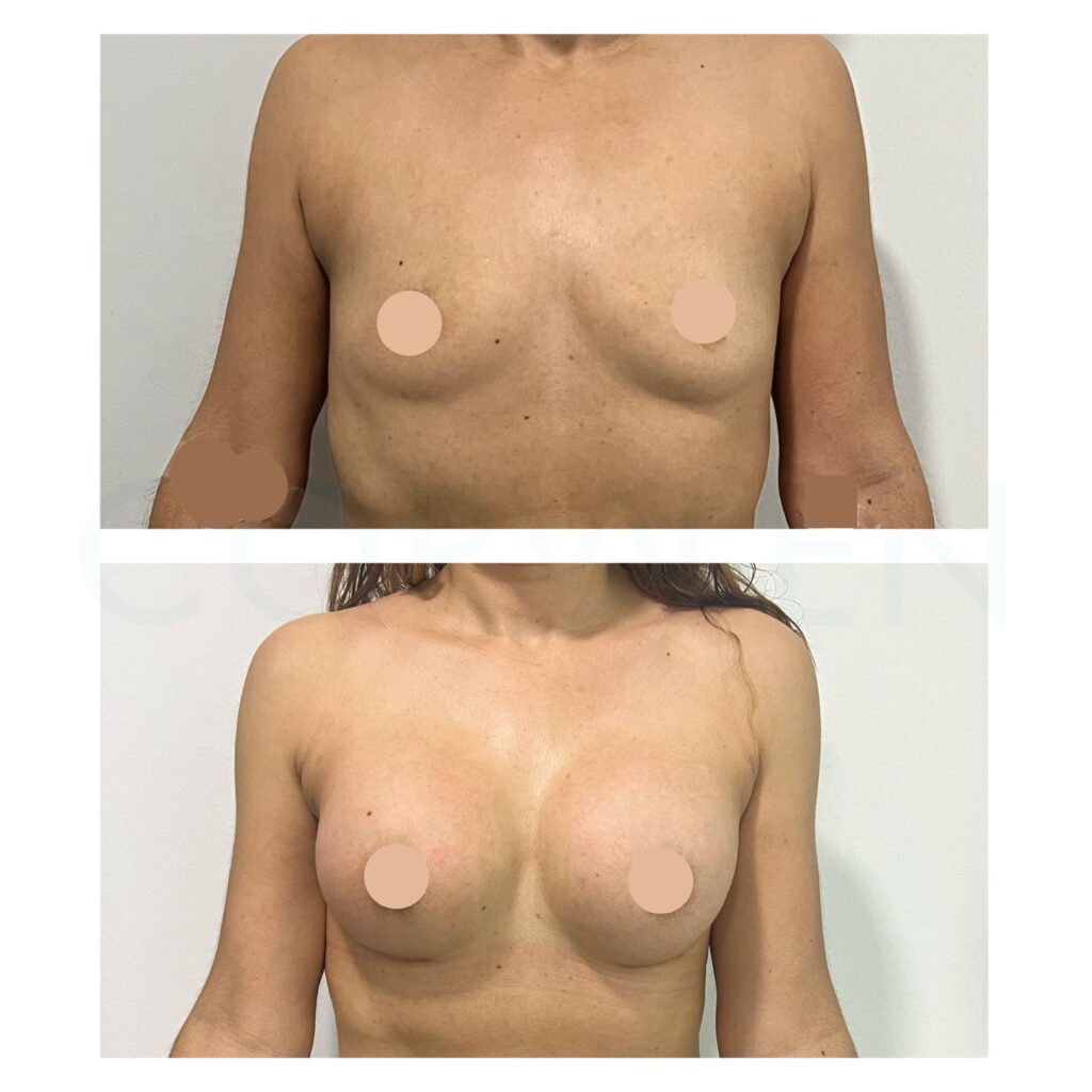 Mamoplastia de aumento mamoplastia de aumento