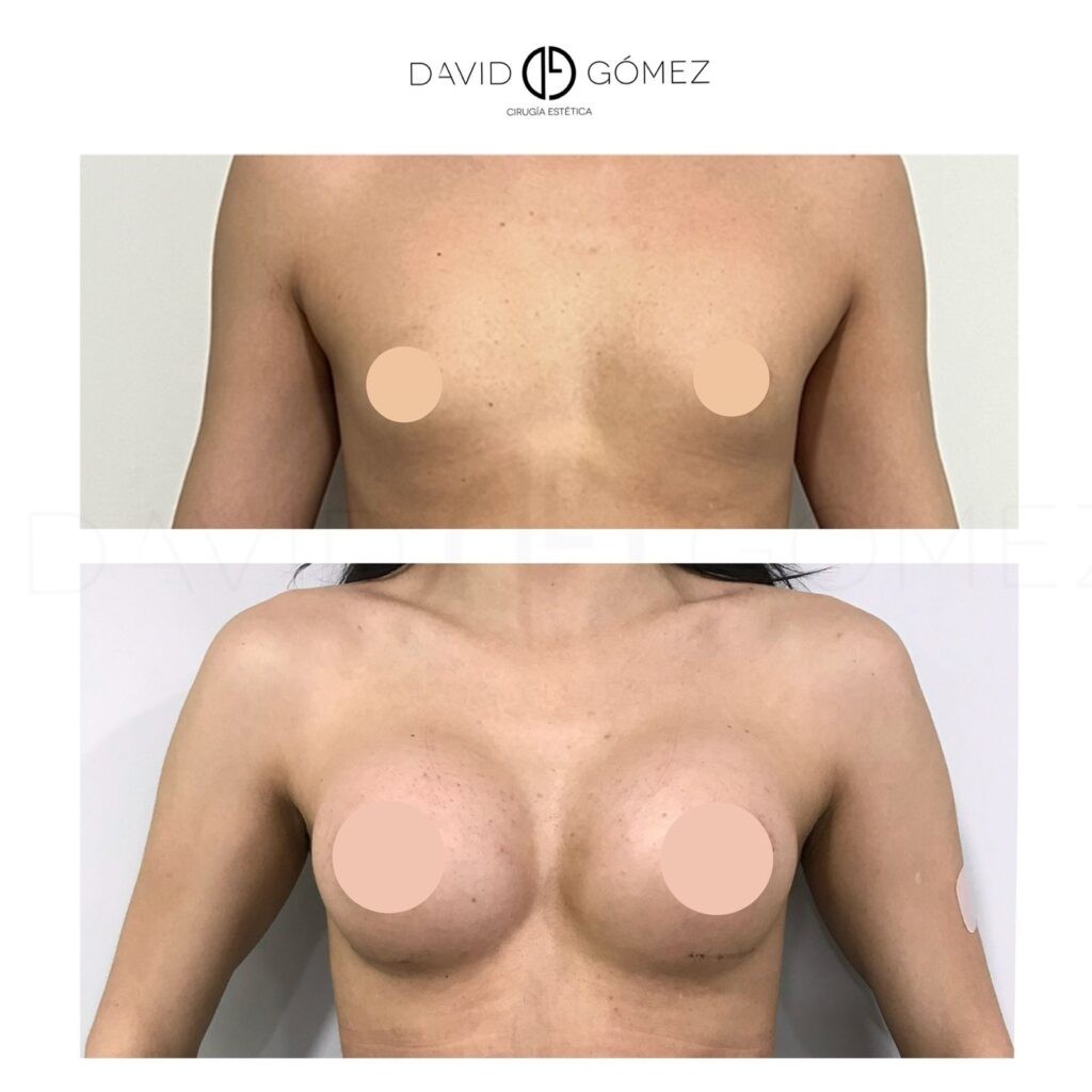 Mamoplastia de aumento mamoplastia de aumento corvalen sugery