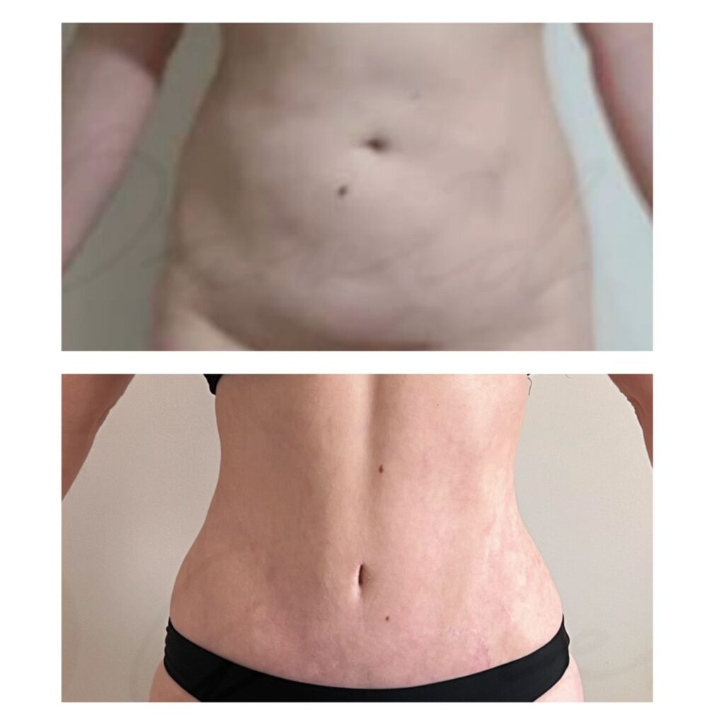 Tummytuck tummy tuck