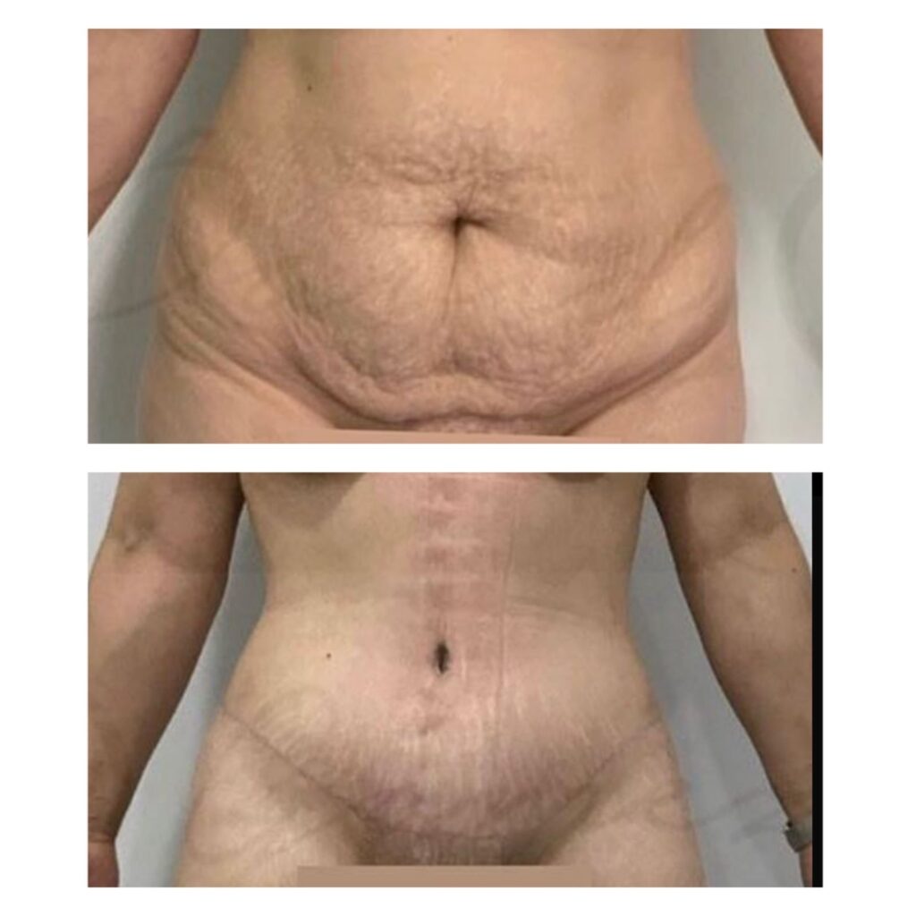 Tummytuck tummytuck cirugía
