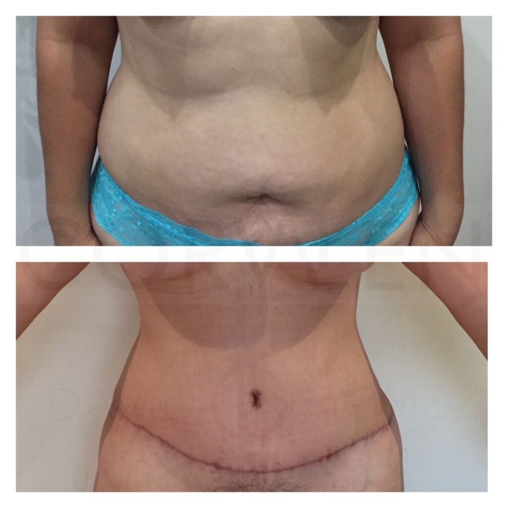 Tummytuck tummytuck cirugía estética