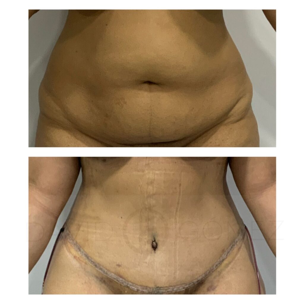 Tummytuck tummytuck corvalen sugery