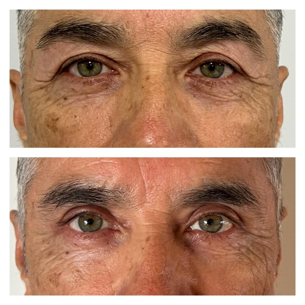 blefaroplastia hombre (1)