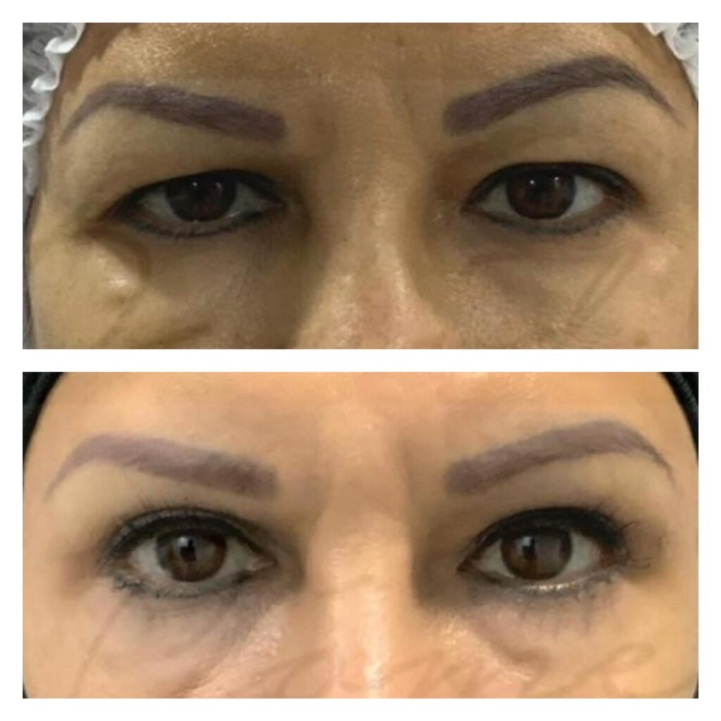 blefaroplastia mujer (1)